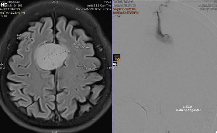 Khối u não có kích thước lớn nằm giữa đỉnh đầu của người bệnh Khối u não có kích thước lớn nằm giữa đỉnh đầu của người bệnh