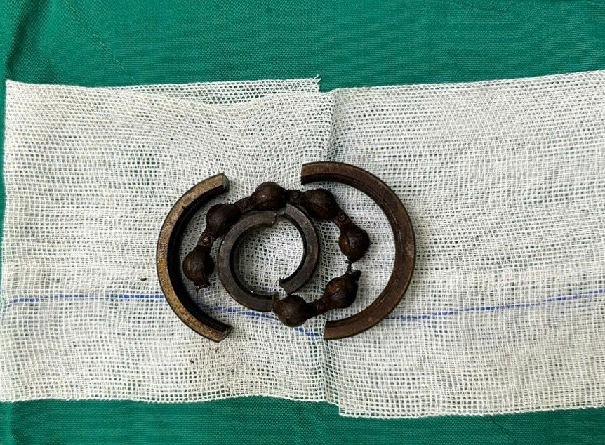 Vòng bạc đạn được các bác sĩ dùng cưa chuyên dụng cắt đôi Vòng bạc đạn được các bác sĩ dùng cưa chuyên dụng cắt đôi