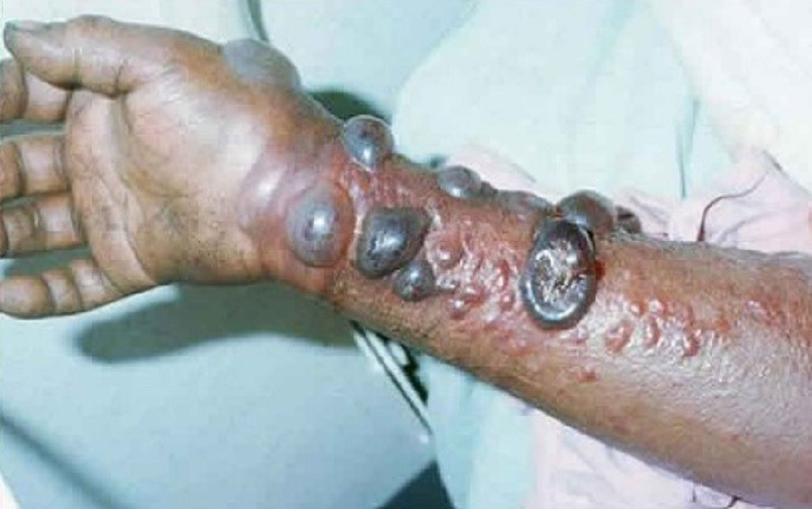 Sang thương trên cánh tay bệnh nhân bị nhiễm vi rút Marburg Sang thương trên cánh tay bệnh nhân bị nhiễm vi rút Marburg