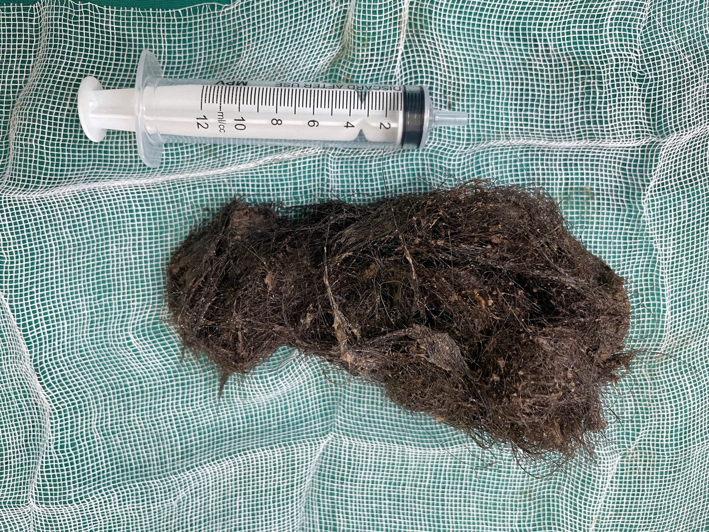 Khối tóc sau khi được bác sĩ lấy từ dạ dày bệnh nhi đã kết chặt với nhau