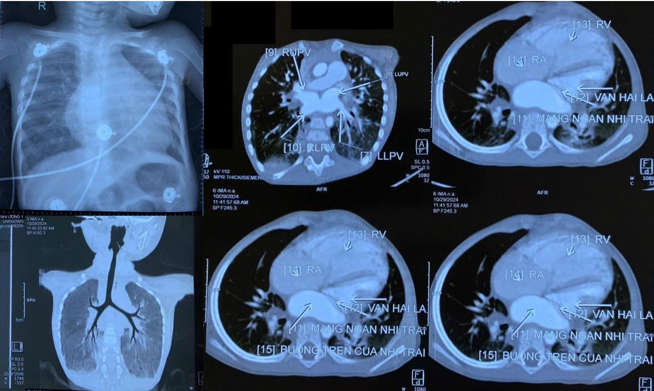 Màng ngăn nhĩ trái là nguyên nhân khiến trẻ bị chẩn đoán bệnh lao, rơi vào nguy kịch Màng ngăn nhĩ trái là nguyên nhân khiến trẻ bị chẩn đoán bệnh lao, rơi vào nguy kịch