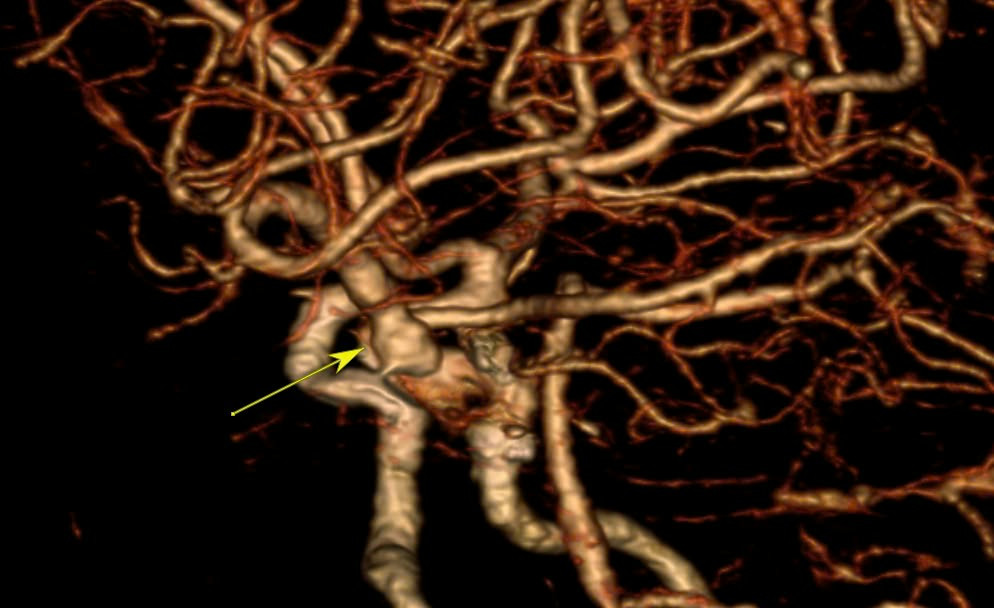 Vị trí túi phình tại động mạch cảnh trong bên trái của người bệnh bị vỡ gây đột quỵ Vị trí túi phình tại động mạch cảnh trong bên trái của người bệnh bị vỡ gây đột quỵ