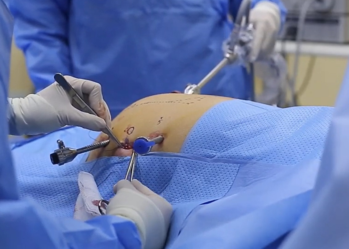 Tình trạng thoát vị khiến rốn của bệnh nhân bị lồi, ruột non chui qua vị trí thoát vị gây tắc ruột