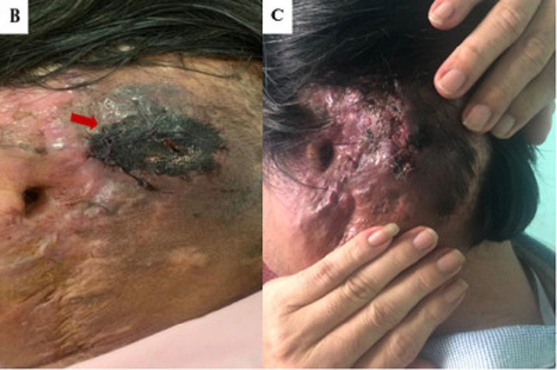 Bệnh nhân đã phải cắt bỏ một bên tai vì những biến chứng trong quá trình điều trị ở nước ngoài