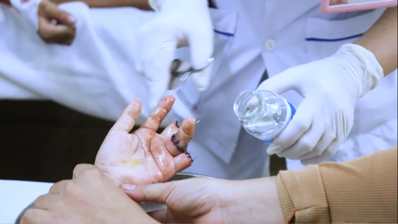 Các bác sĩ đã nối thành công ngón tay số 4 cho bệnh nhi nhưng trẻ phải chịu cảnh thương tật vì mất 2 ngón