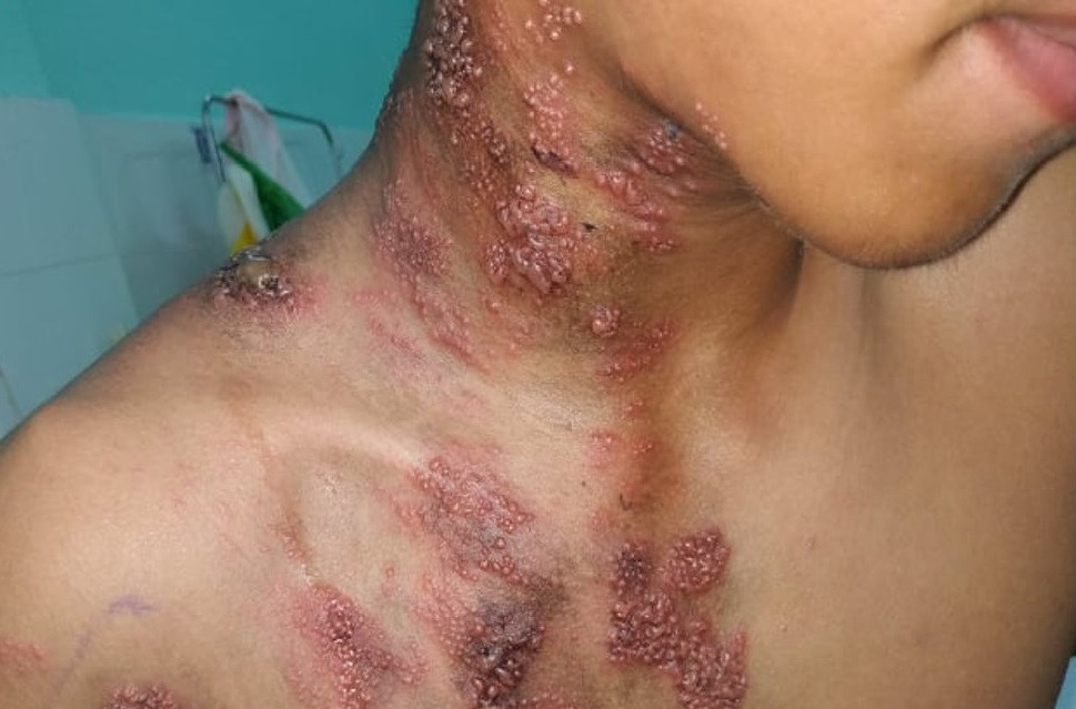 Zona là căn bệnh gây nhiều đau đớn cho bệnh nhân, tiêm vắc xin là giải pháp tránh nguy cơ mắc bệnh