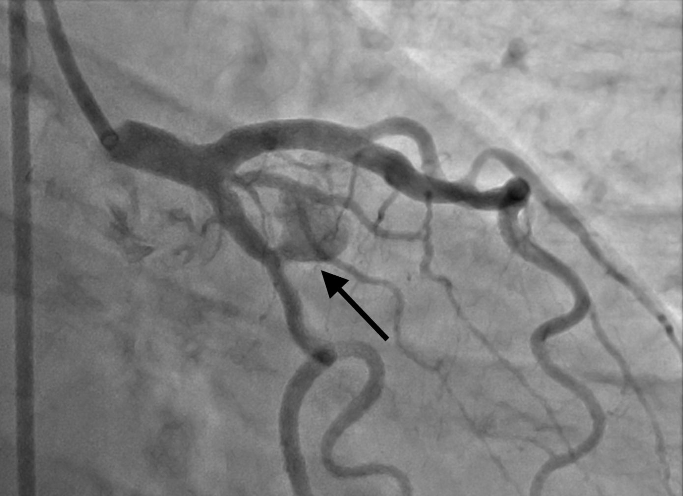 Túi giả phình (vị trí đầu mũi tên) trên hình ảnh kiểm tra cho người bệnh trước khi can thiệp Túi giả phình (vị trí đầu mũi tên) trên hình ảnh kiểm tra cho người bệnh trước khi can thiệp
