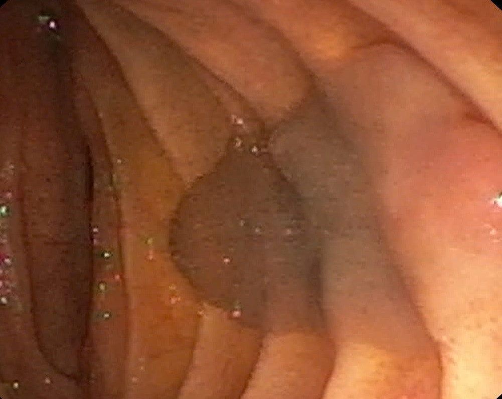 Sán lá gan được phát hiện trên hình ảnh camera nội soi Sán lá gan được phát hiện trên hình ảnh camera nội soi