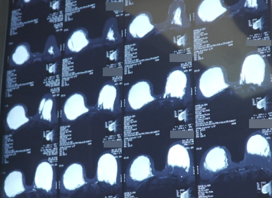 Hai bầu ngực của nữ Việt kiều phát sáng trên kết quả kiểm tra MRI Hai bầu ngực của nữ Việt kiều phát sáng trên kết quả kiểm tra MRI