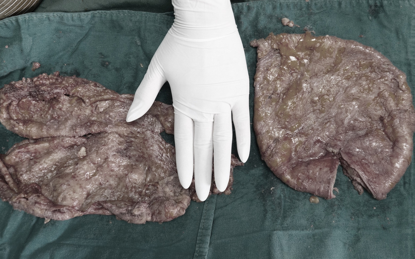 2 túi bao xơ được bóc tách khỏi ngực người bệnh để ngăn chặn nguy cơ nhiễm trùng, hoại tử tái phát 2 túi bao xơ được bóc tách khỏi ngực người bệnh để ngăn chặn nguy cơ nhiễm trùng, hoại tử tái phát