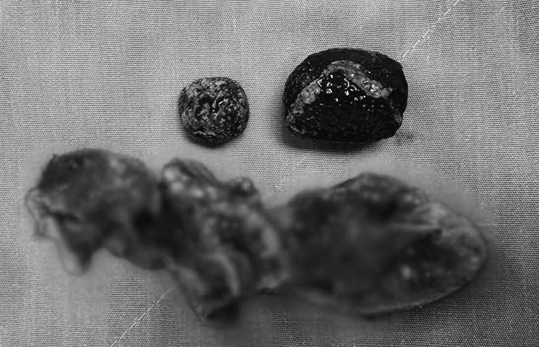 Túi mật bị viêm nhiễm và những viên sỏi lớn được lấy ra khỏi cơ thể người bệnh