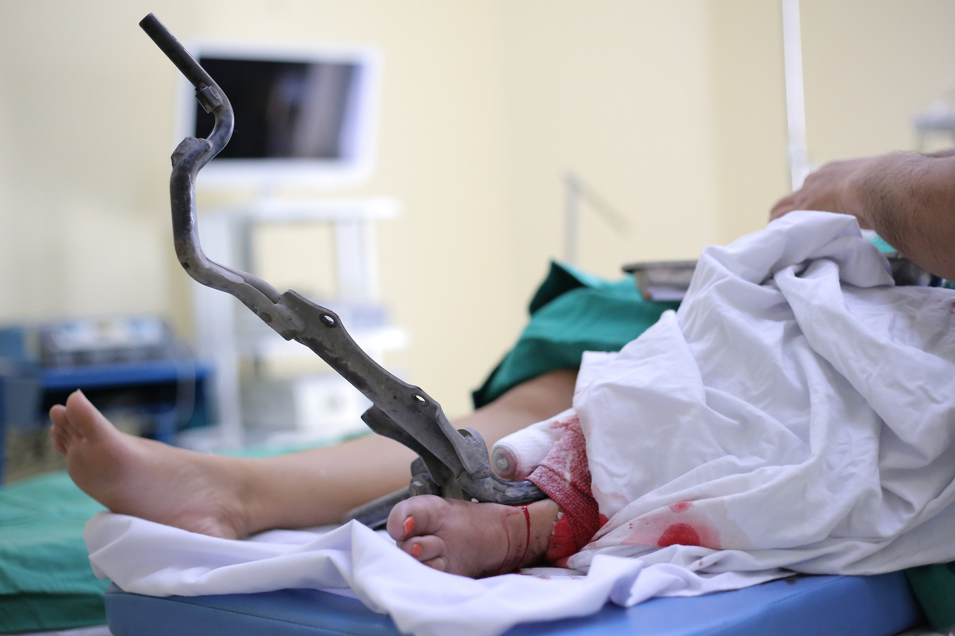 Chiếc chân chống xe gắn máy đâm xuyên cẳng chân nạn nhân thời điểm nhập viện