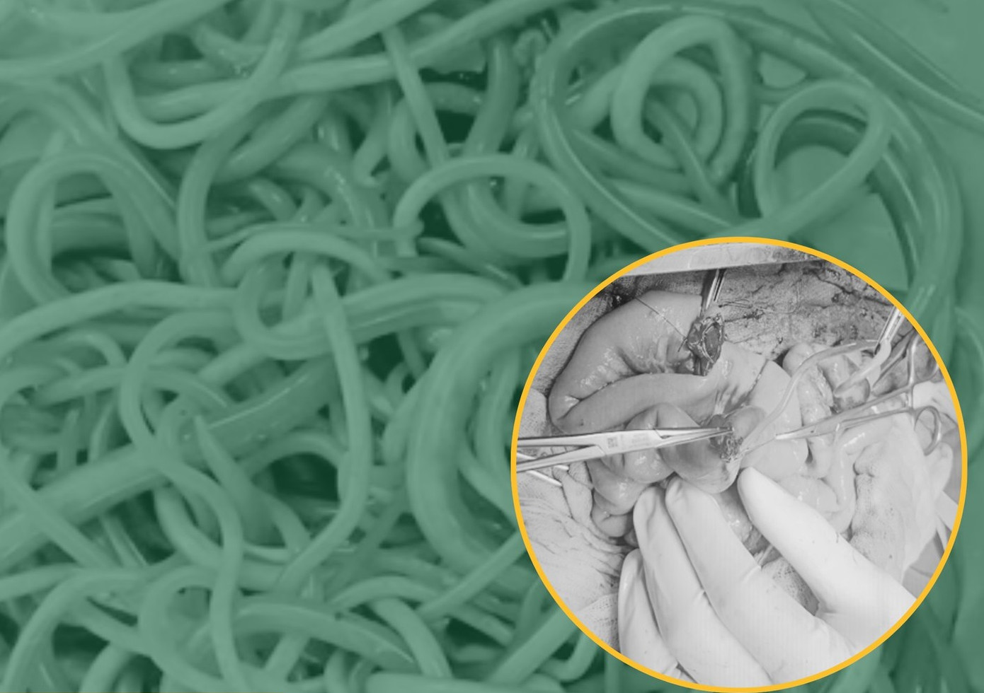 Các bác sĩ phải xẻ ruột non ở nhiều vị trí khác nhau để lấy trọn búi giun đũa ký sinh (ảnh: BVCC) Các bác sĩ phải xẻ ruột non ở nhiều vị trí khác nhau để lấy trọn búi giun đũa ký sinh (ảnh: BVCC)