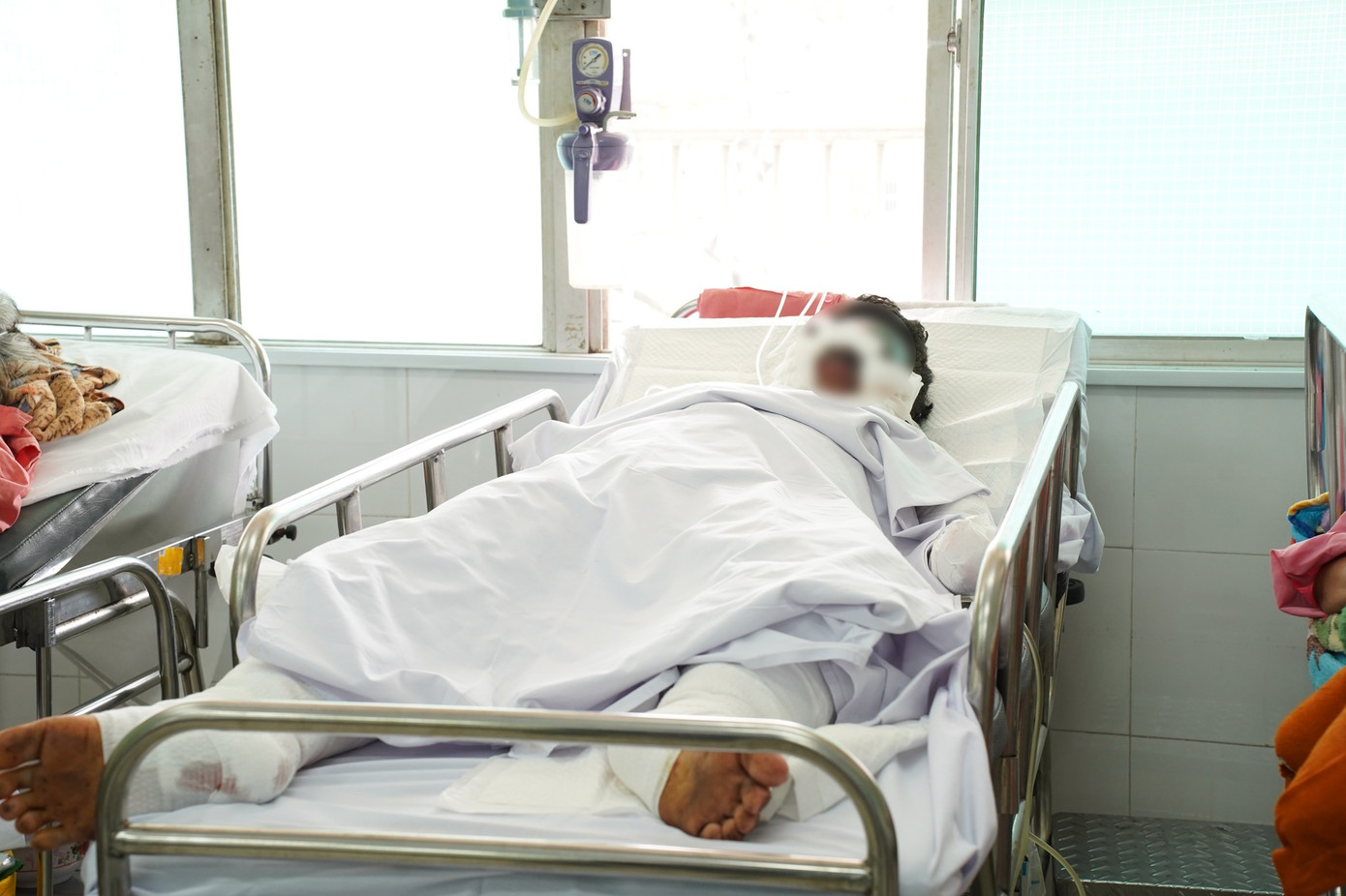 Một trường hợp nguy kịch sau tai nạn pháo tự chế, phải cắt cụt tay trái bị dập nát để tránh nguy hiểm đến tính mạng