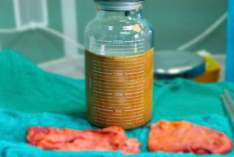 Khoảng 2 lít dịch bốc mùi hôi thối đã được hút ra khỏi cơ thể người bệnh Khoảng 2 lít dịch bốc mùi hôi thối đã được hút ra khỏi cơ thể người bệnh