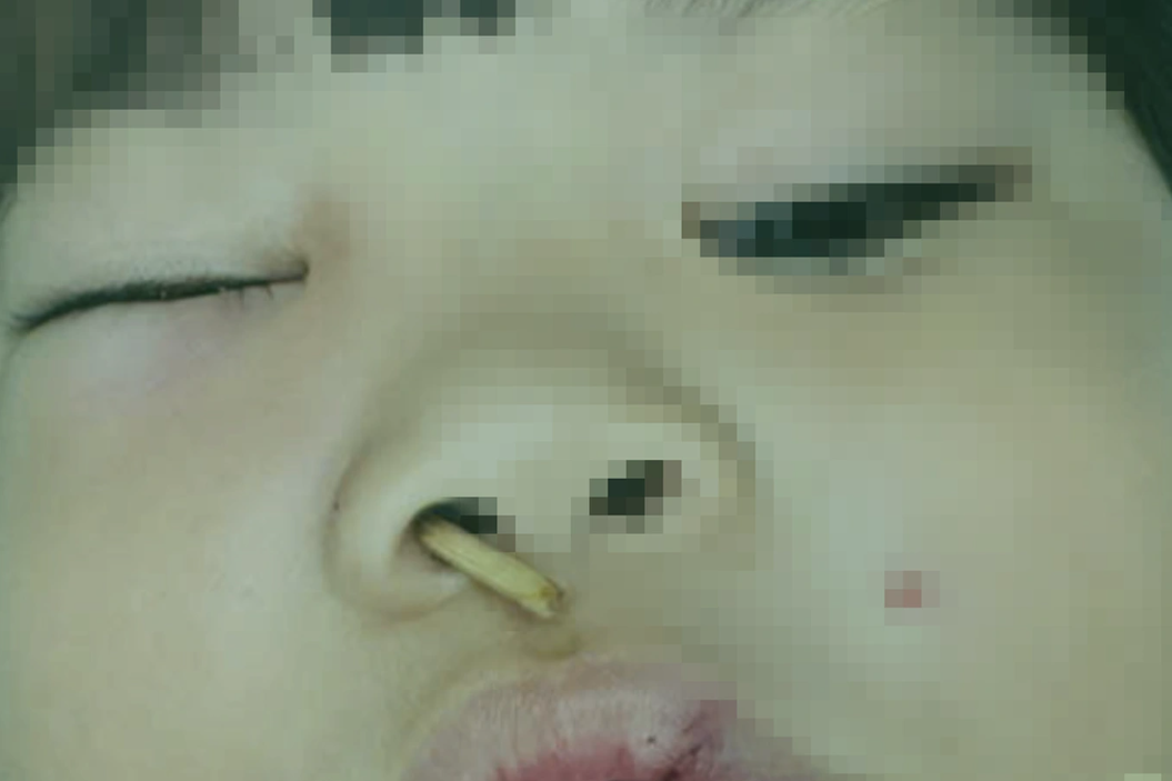 Thời điểm nhập viện, bệnh nhi bị cây que xiên thịt đâm xuyên từ mũi lên hốc mắt bên phải Thời điểm nhập viện, bệnh nhi bị cây que xiên thịt đâm xuyên từ mũi lên hốc mắt bên phải