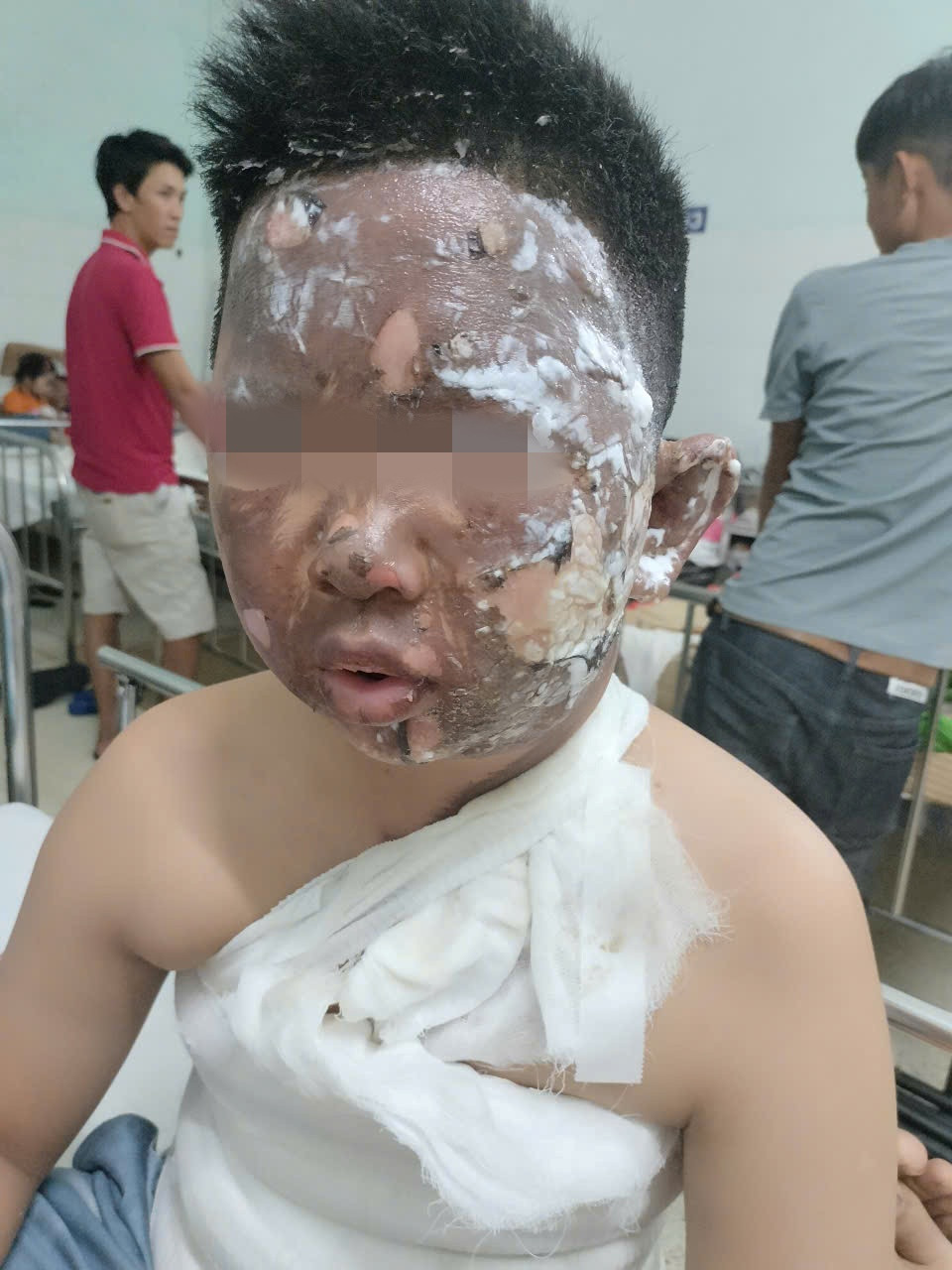 Bệnh nhi bị thương nặng khi chơi pháo tự chế được điều trị tại Bệnh viện Nhi Đồng 2 Bệnh nhi bị thương nặng khi chơi pháo tự chế được điều trị tại Bệnh viện Nhi Đồng 2