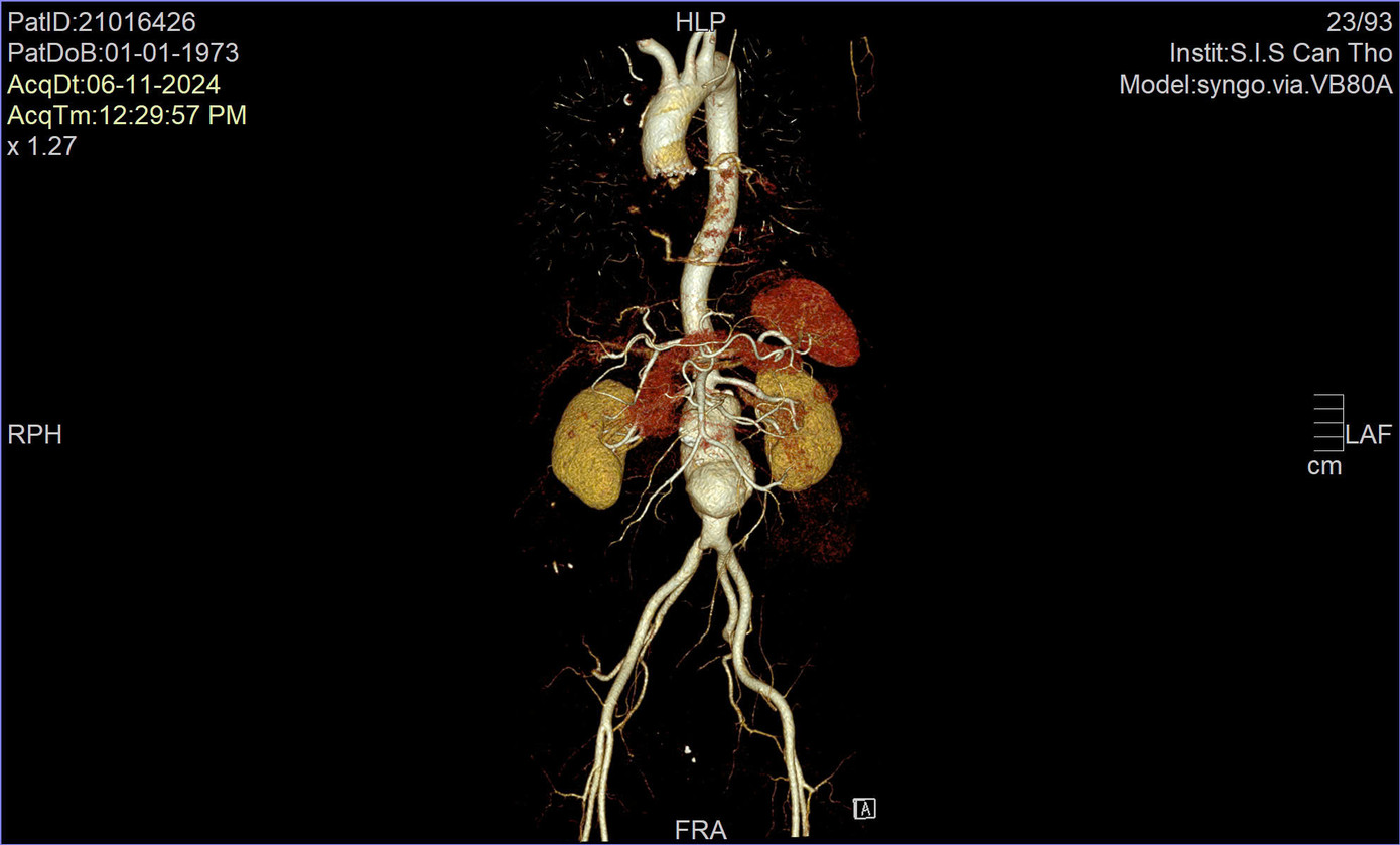 Động mạch chủ bụng của bệnh nhân bị phình lớn dọa vỡ, đe dọa tính mạng Động mạch chủ bụng của bệnh nhân bị phình lớn dọa vỡ, đe dọa tính mạng