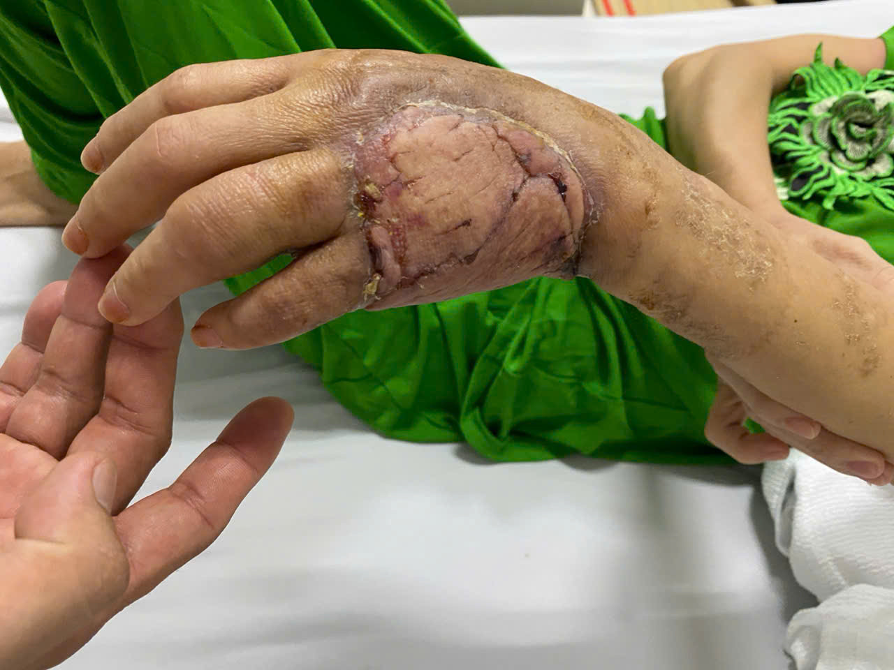 Vị trí da tự thân được ghép trên bàn tay bệnh nhân đã sống tốt