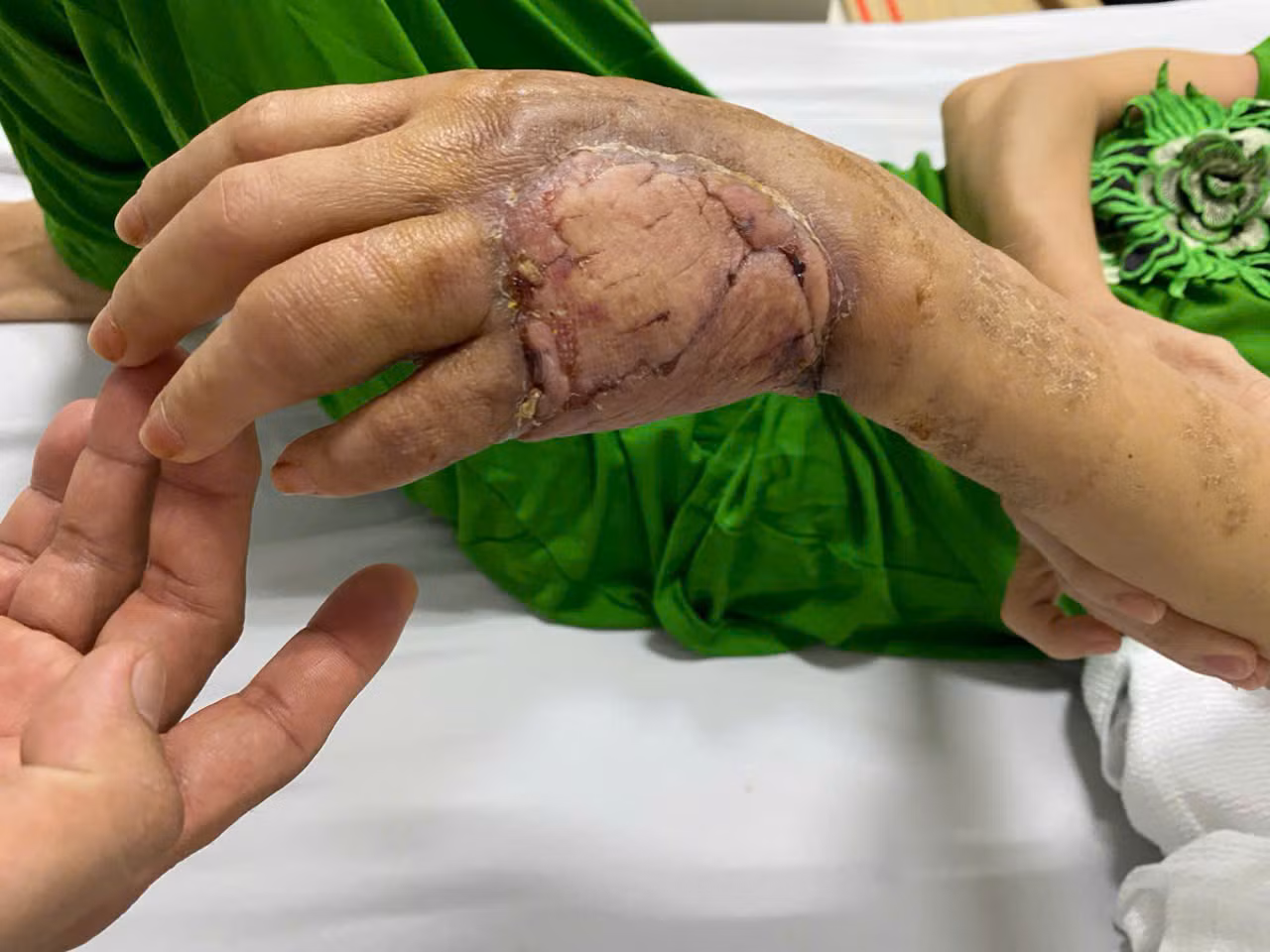 Vị trí da tự thân được ghép trên bàn tay bệnh nhân đã sống tốt Vị trí da tự thân được ghép trên bàn tay bệnh nhân đã sống tốt