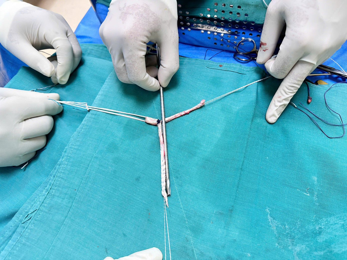 Đoạn gân tự thân được lấy từ khớp gối để tái tạo lại dây chằng ngoài khớp cổ chân cho người bệnh