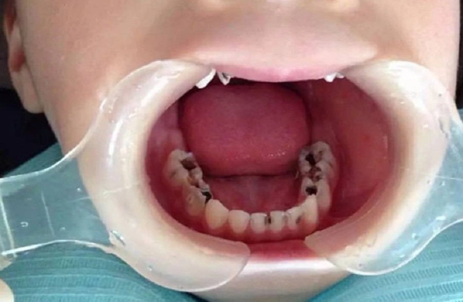 Hơn 85% trẻ em từ 6-8 tuổi ở Việt Nam bị sâu răng Hơn 85% trẻ em từ 6-8 tuổi ở Việt Nam bị sâu răng