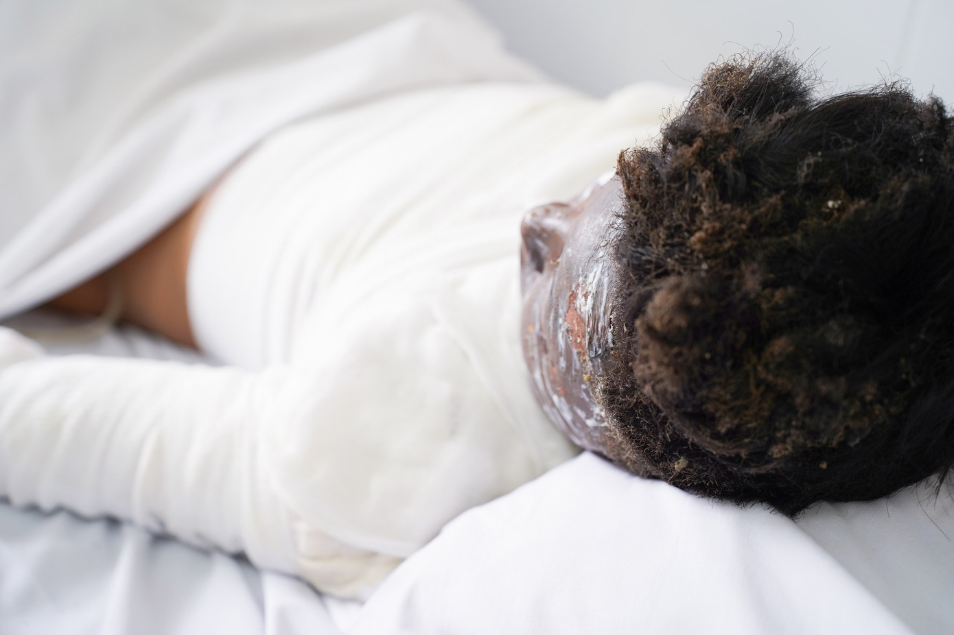 Thương tích do hỏa khí khiến bệnh nhân bị bỏng, đa chấn thương, nguy kịch tính mạng