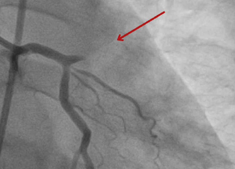 Hình ảnh kiểm tra cho thấy bệnh nhân bị tắc gần như hoàn toàn động mạch vành bên trái Hình ảnh kiểm tra cho thấy bệnh nhân bị tắc gần như hoàn toàn động mạch vành bên trái