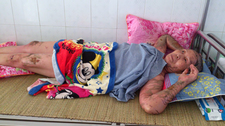 Tuổi già sức yếu, nay lại bị tạt axit khiến cụ Lê Thị Lý vô cùng đau đớn. Ảnh: Tuấn Nguyễn