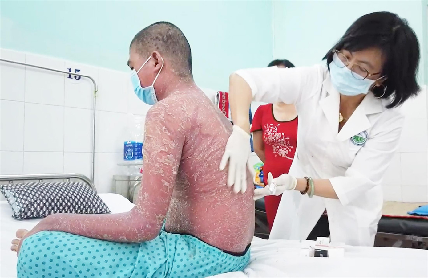 Bệnh nhân bị lột da toàn thân sau khi sử dụng thuốc trôi nổi trị vảy nến