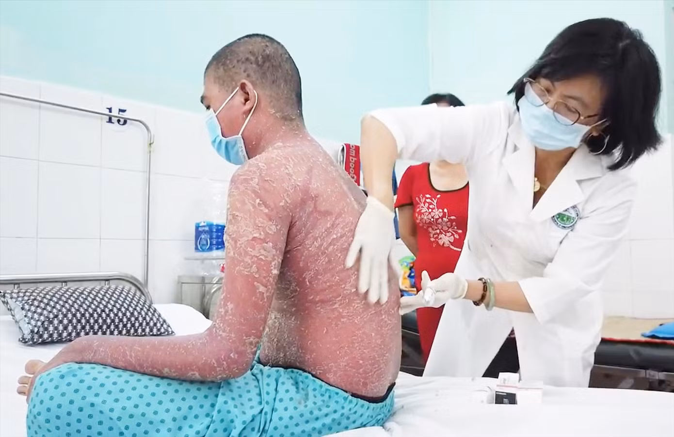 Bệnh nhân bị lột da toàn thân sau khi sử dụng thuốc trôi nổi trị vảy nến