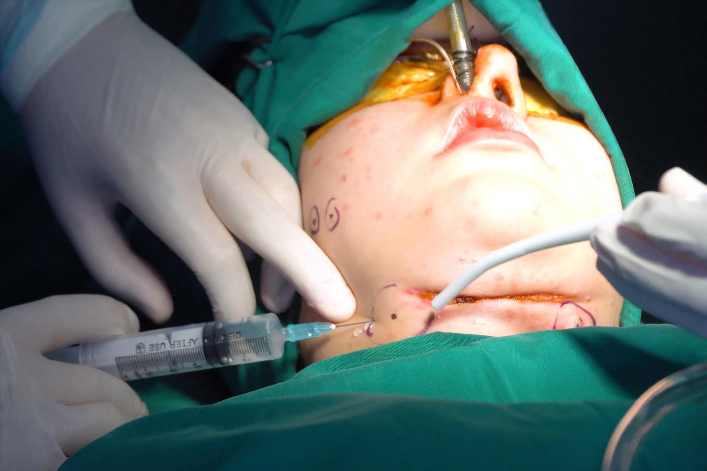 Nữ bệnh nhân bị hoại tử vùng cổ sau khi bơm chất lạ làm tan mỡ nọng