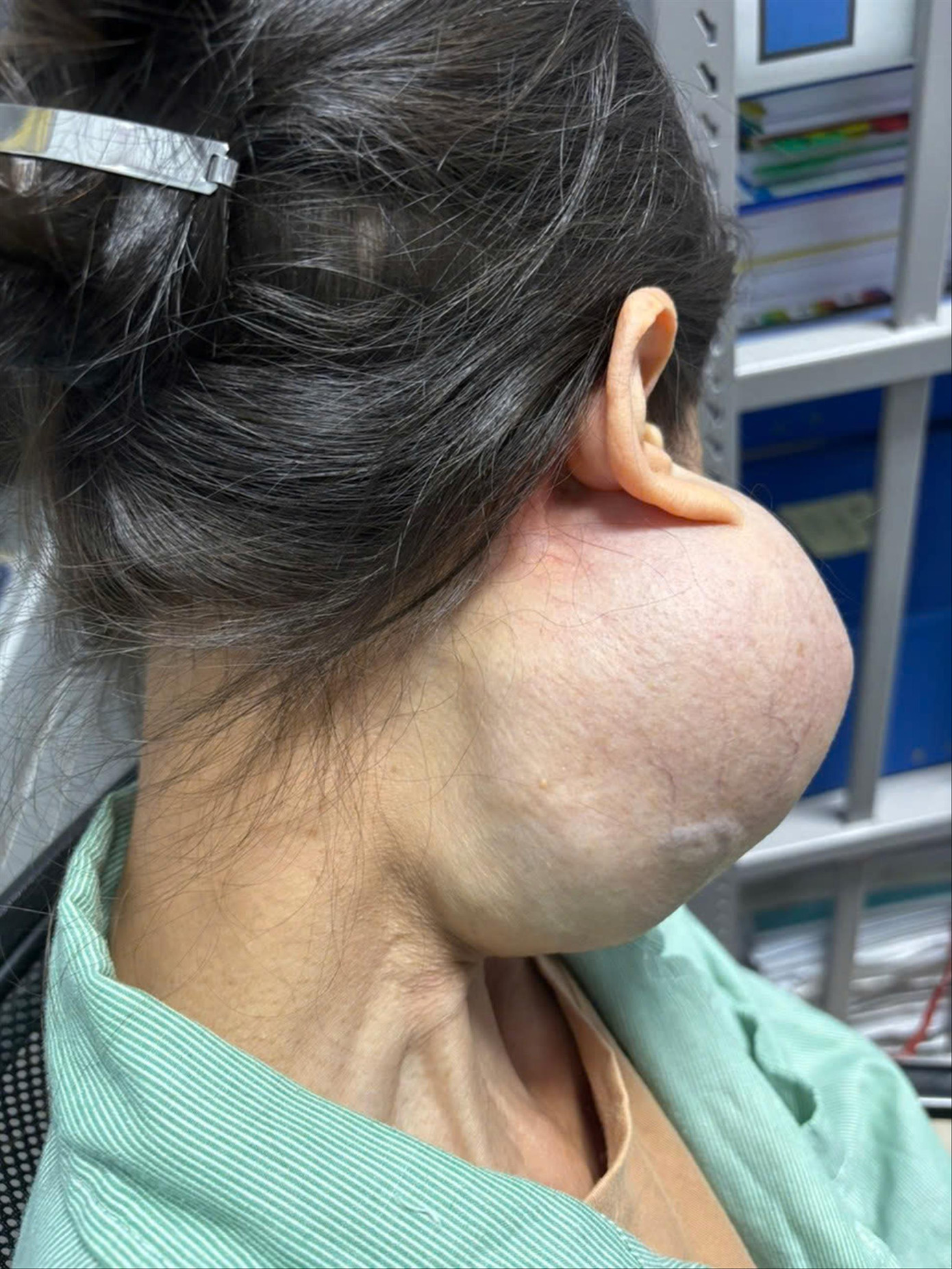 Bệnh nhân với khối u khổng lồ trên mặt