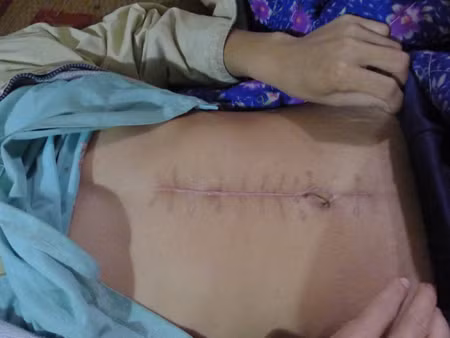 Bị vỡ xương, dập gan...trong vụ tai nạn khiến chị phải trải đến viện mổ cấp cứu 