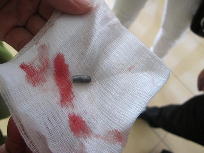 Đầu đạn được gắp ra từ đùi phải của trung sĩ Bùi Văn Tuấn. Đầu đạn được gắp ra từ đùi phải của trung sĩ Bùi Văn Tuấn