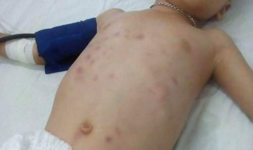 Trận đòn trong bữa ăn khiến bé 6 tuổi bị đa chấn thương, thủng ruột ảnh 1