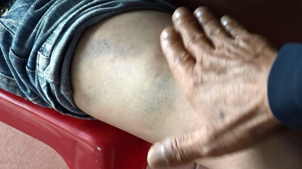 Trốn học đi đá bóng, nam sinh lớp 8 bị bố cùng mẹ kế đánh dã man ảnh 2