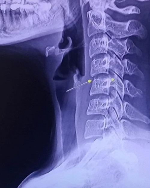 Việc massage mạnh ở vùng cổ là rất nguy hiểm. Ảnh: The Nation/ Asia News Network.