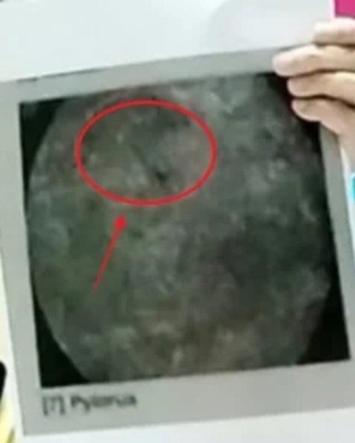 Cây kim vẫn chưa được lấy ra. Ảnh: SCMP.