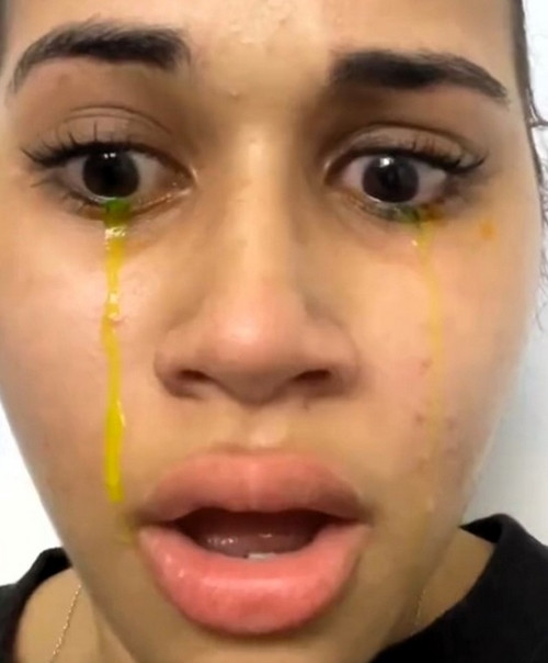 Pillay khóc ra nước mắt màu vàng như được nhuộm. Ảnh: Lekeisha Christobel Pillay. Pillay khóc ra nước mắt màu vàng như được nhuộm. Ảnh: Lekeisha Christobel Pillay.