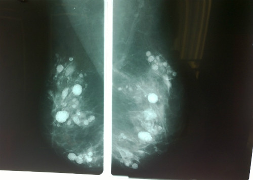 Hình ảnh X quang tuyến vú của bệnh nhân có rất niều nốt, dầy đặc trong mô vú, không thể phân biệt với khối u. Ảnh: BVCC.