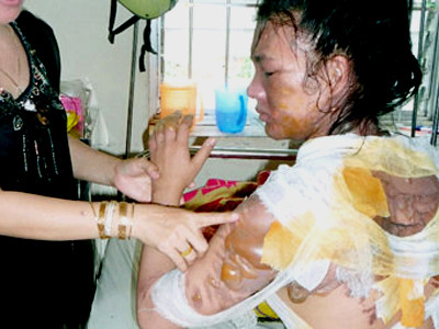 Người chồng nhẫn tâm đã đổ cả nồi nước sôi lên người vợ khiến chị Thy bị bỏng nặng. Người chồng nhẫn tâm đã đổ cả nồi nước sôi lên người vợ khiến chị Thy bị thương nặng
