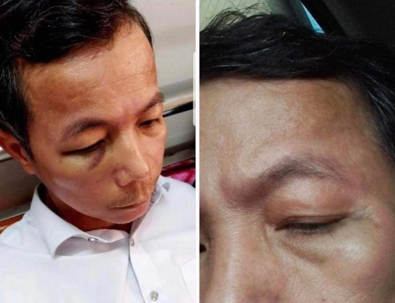 Ông Huấn bị cấp trên của mình đánh thâm tím mặt Ông Huấn bị cấp trên của mình đánh thâm tím mặt