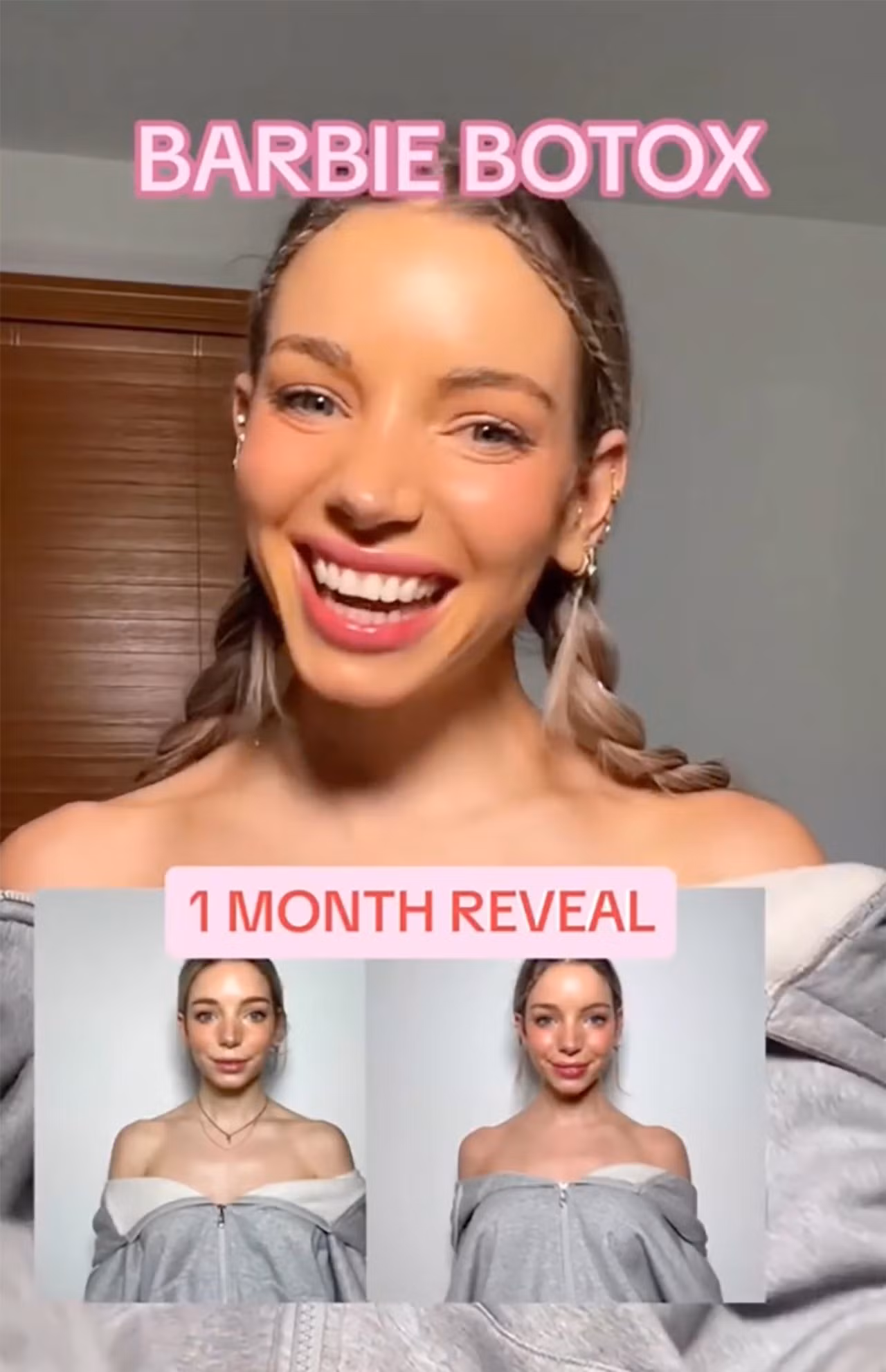 Isabelle Lux tiêm Botox để có được bờ vai thon thả và chiếc cổ thon dài như búp bê Barbie. Ảnh: TikTok.