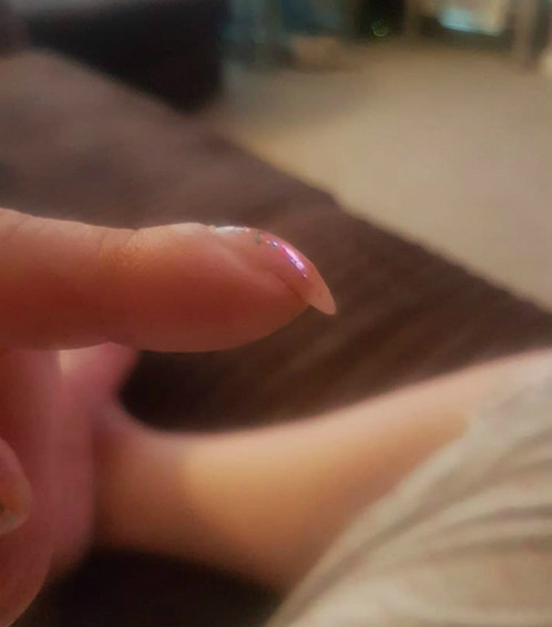 Móng tay quặp cảnh báo ung thư phổi ảnh 1