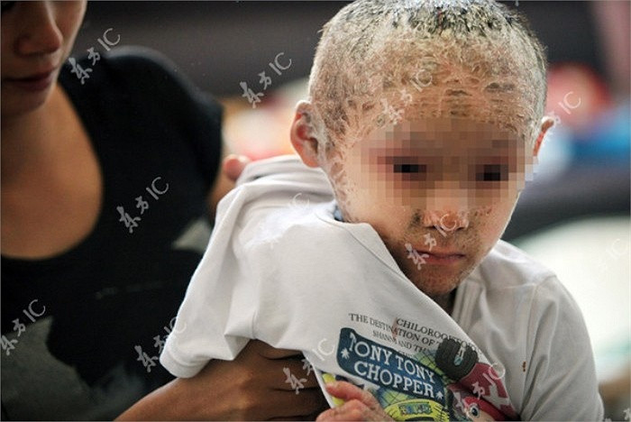 Căn bệnh khiến bé luôn cảm thấy ngứa ngáy và nóng bức trong người