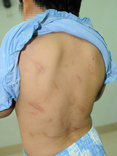 Cháu Quỳnh với nhiều vết thương trên thân thể. Cháu Quỳnh với nhiều vết thương trên thân thể