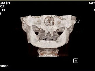 Phim X-quang cho thấy sự bất thường về hàm răng