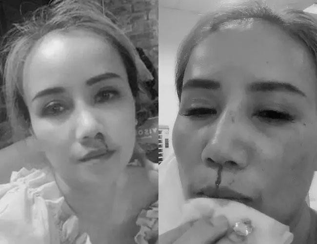 Hình ảnh nữ diễn viên bị chồng cũ hành hung khiến nhiều người xót xa.