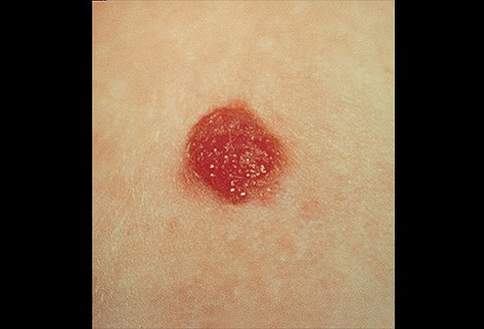  Spitz nevus: nốt ruồi 1cm màu đỏ hình vòm đột nhiên xuất hiện trên vai của một đứa trẻ